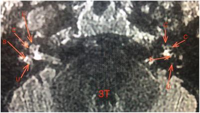 Comparison between 1.5 and 3-Tesla MRI findings in Ménière’s disease